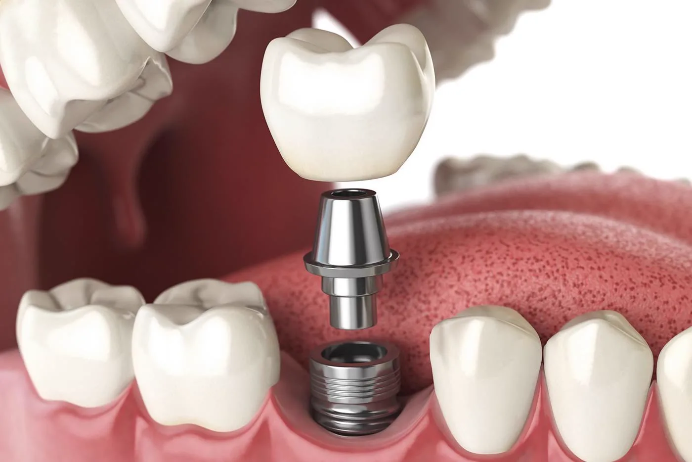 Dental implant tedavisi — bilgilendirme görseli