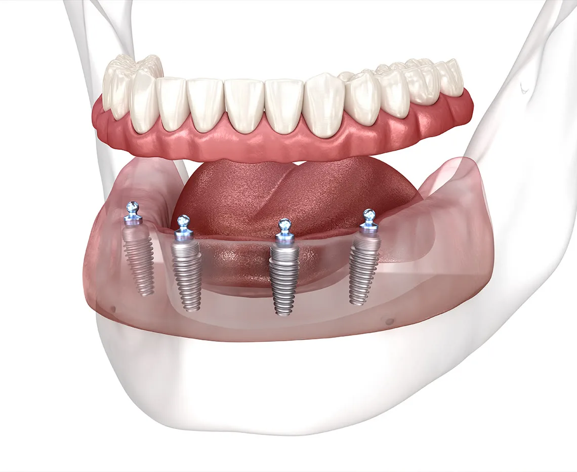 Dental implant tedavi seçenekleri — bilgilendirme görseli