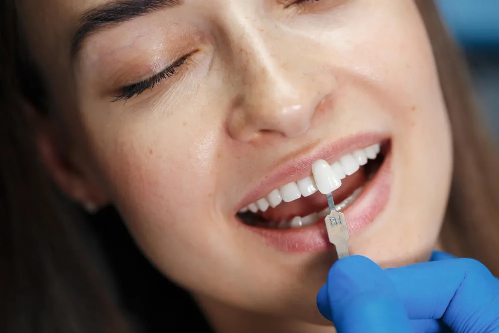 Gülüş tasarımı nedir? — bilgilendirme görseli