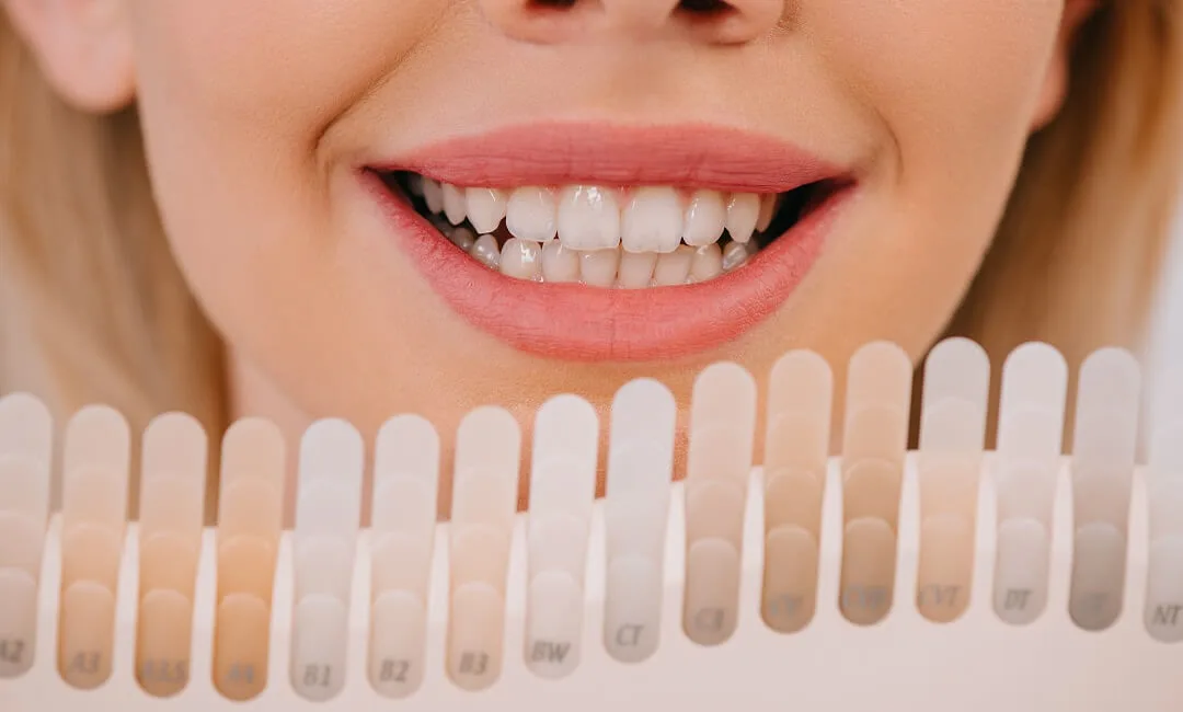 Diş kaplaması nedir? — bilgilendirme görseli